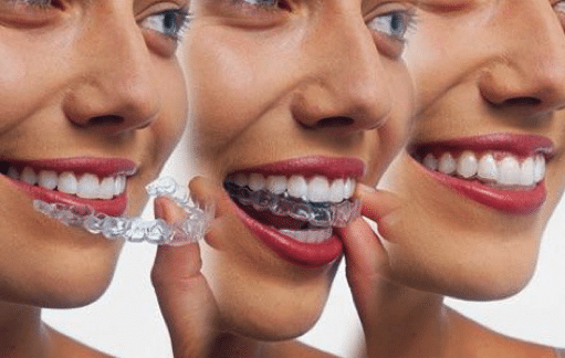 Invisalign Ely - Clear and Removeable Invisalign Braces